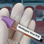 Viruela Símica, Actualización epidemiológica y manejo clínico
