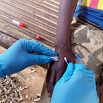 Tomando una muestra del virus de Mpox en un paciente afectado