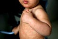 Child with measles