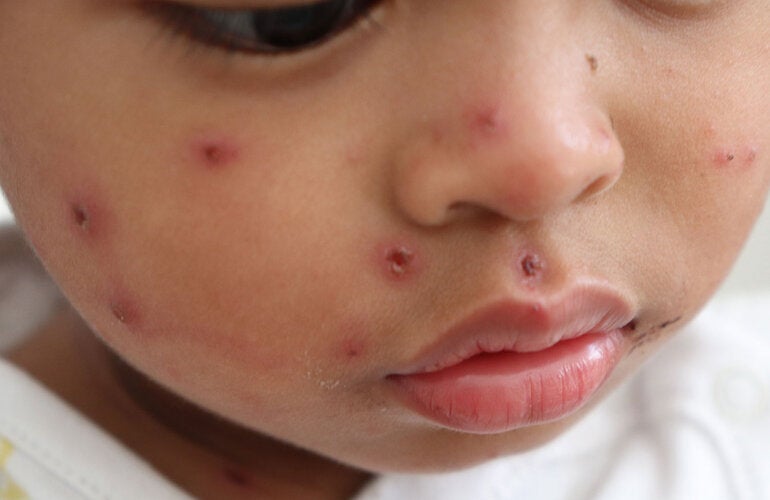 Child with measles