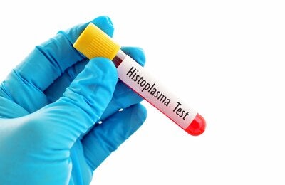 Buscan mejorar diagnóstico y manejo de la histoplasmosis, que afecta a más de 15.000 personas con VIH cada año en las Américas