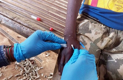 Tomando una muestra del virus de Mpox en un paciente afectado