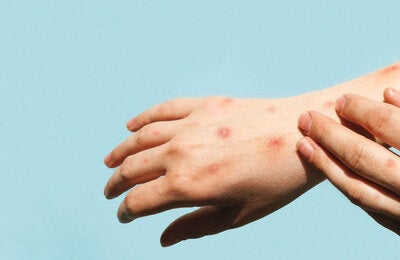 Hands with mpox skin lesions.