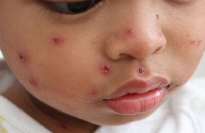 Child with measles