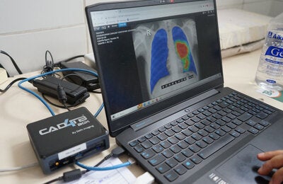 Imágenes de diagnóstico de la tuberculosis