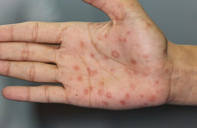 Image of a hand with lesions caused by syphilis