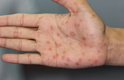 Hand with syphilis signs