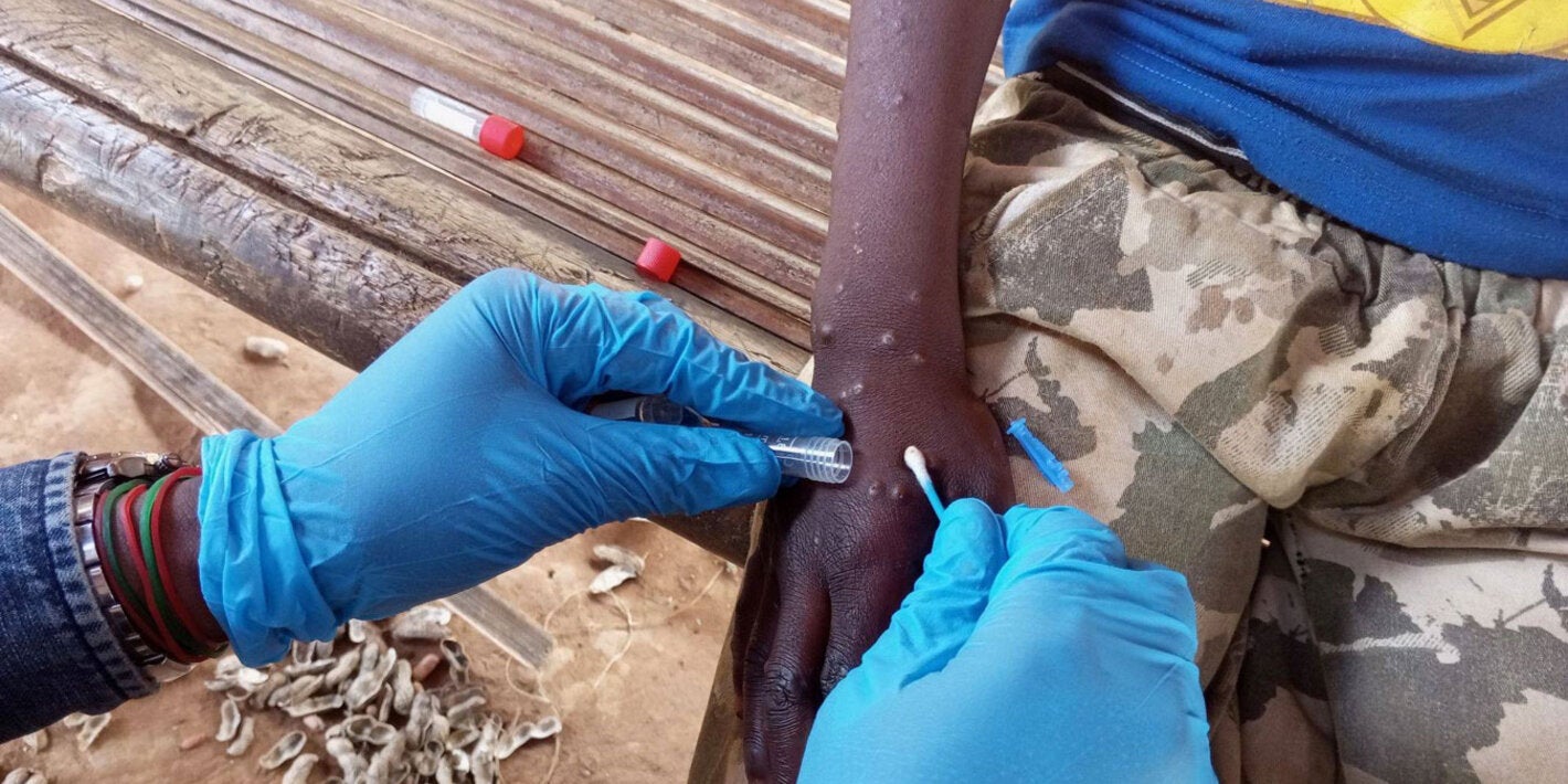 Tomando una muestra del virus de Mpox en un paciente afectado