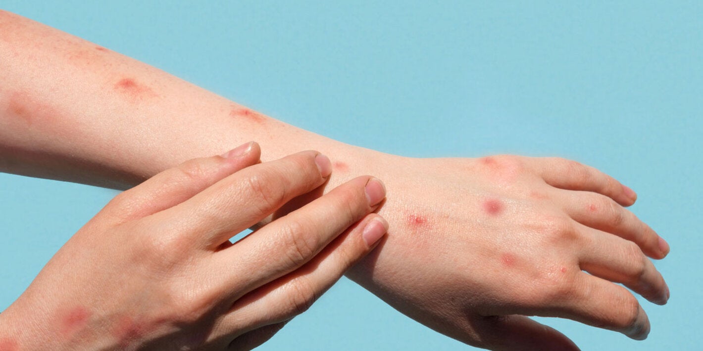 Hand with Mpox rash