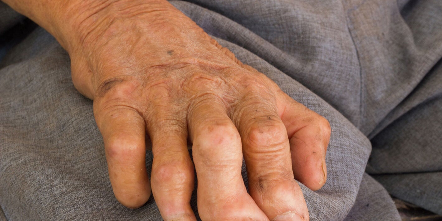 Left hand of a older man impacted by leprosy