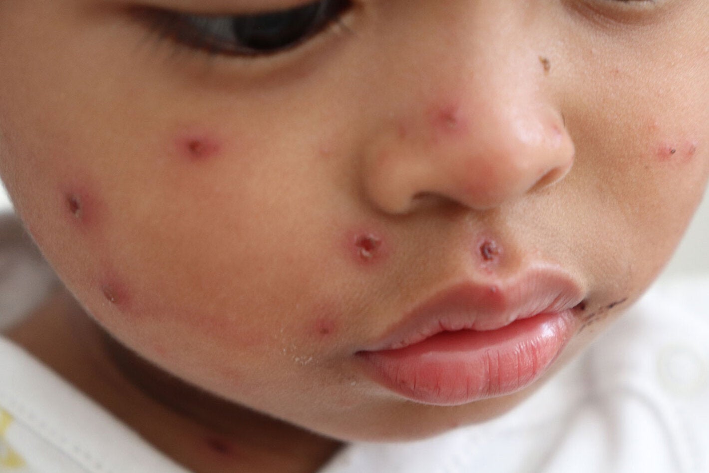 Child with measles