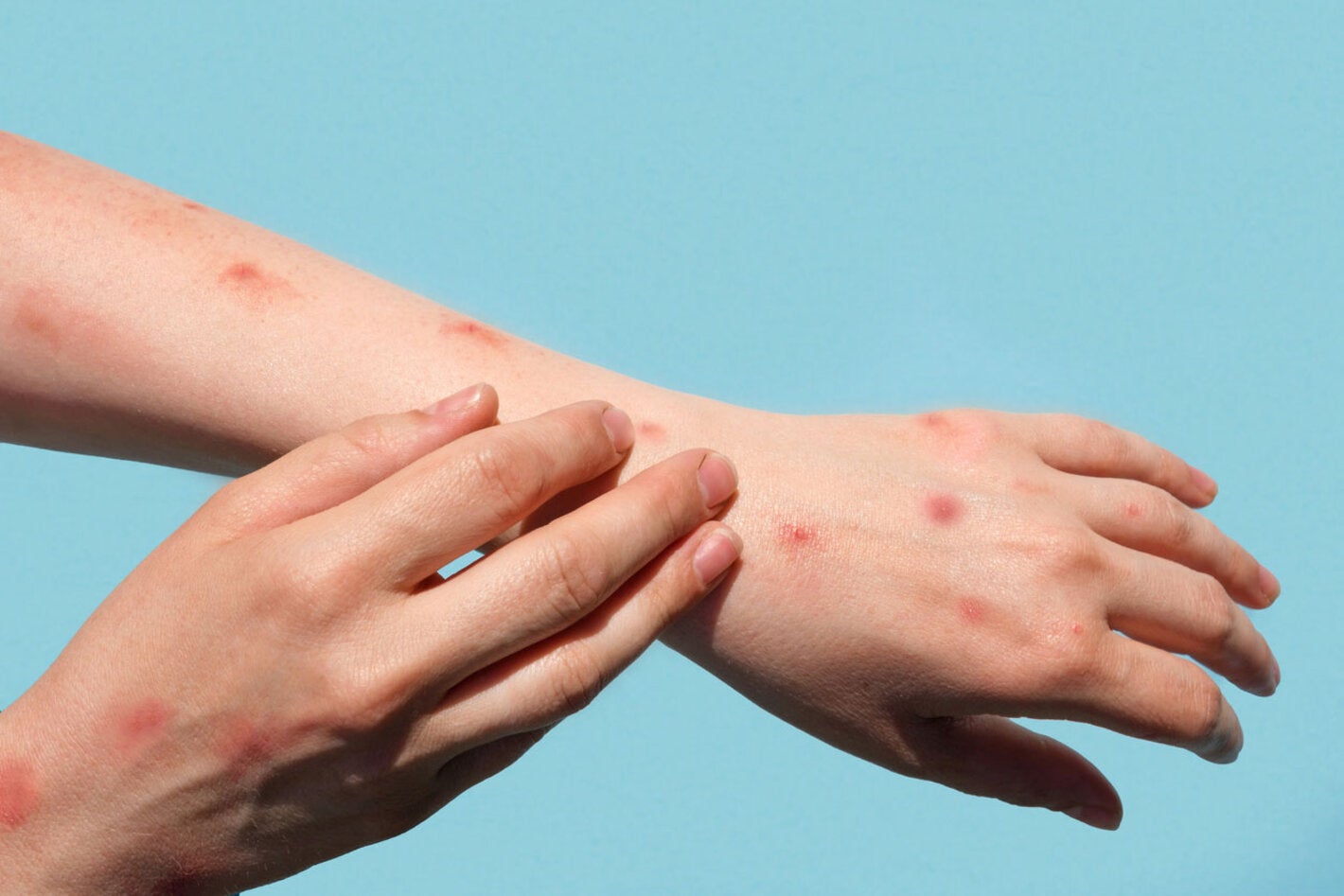 Hand with Mpox rash