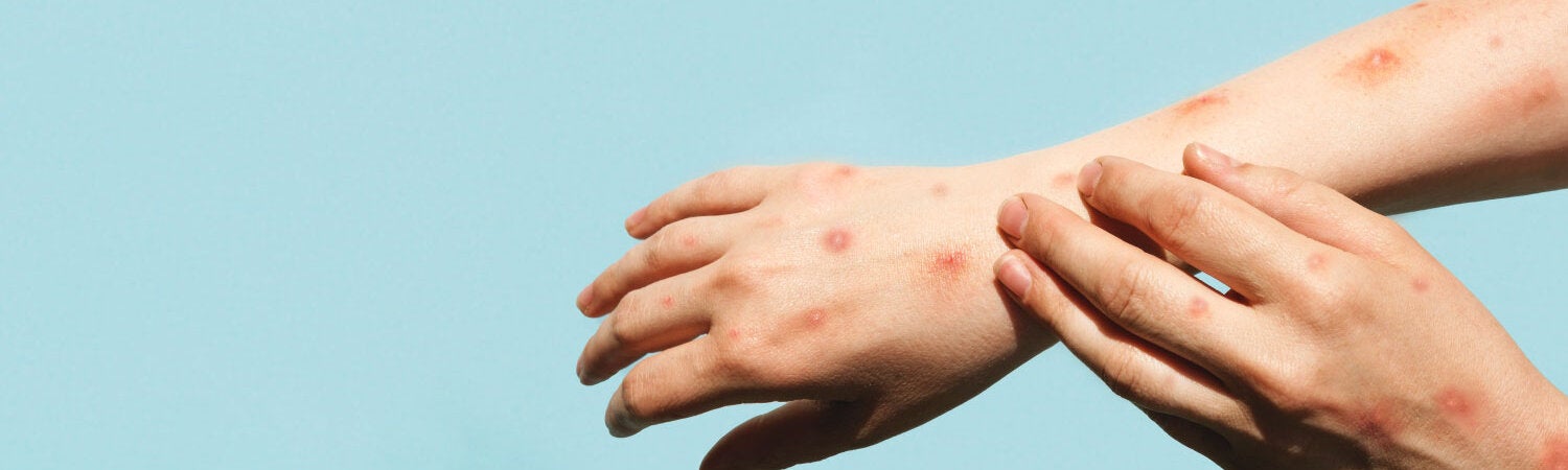 Hands with mpox skin lesions.