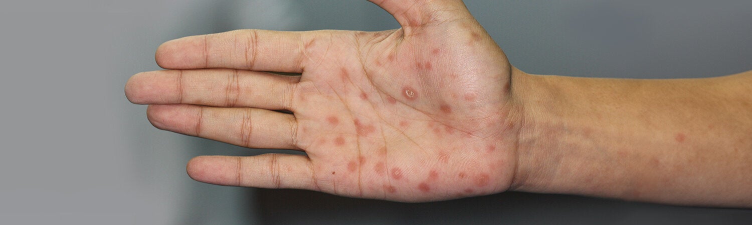 Image of a hand with lesions caused by syphilis