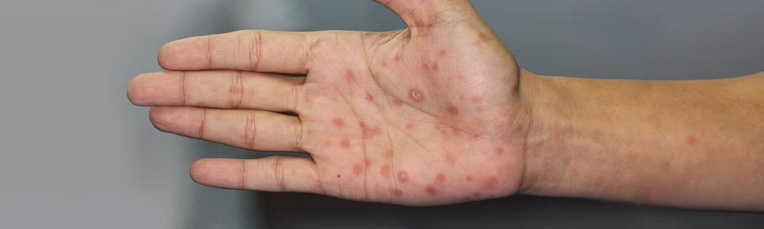 Hand with syphilis signs